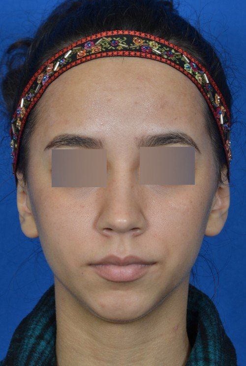 before chin implant