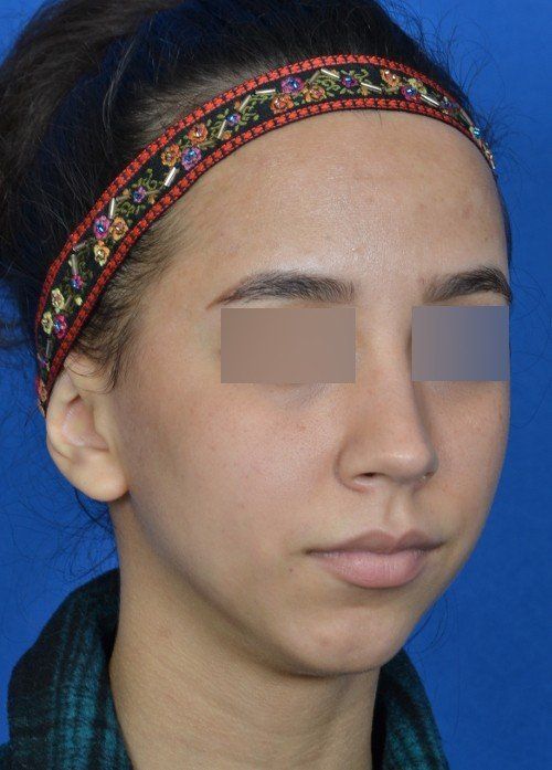 before chin implant