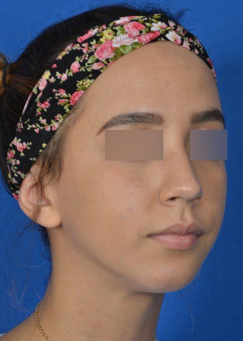 after chin implant