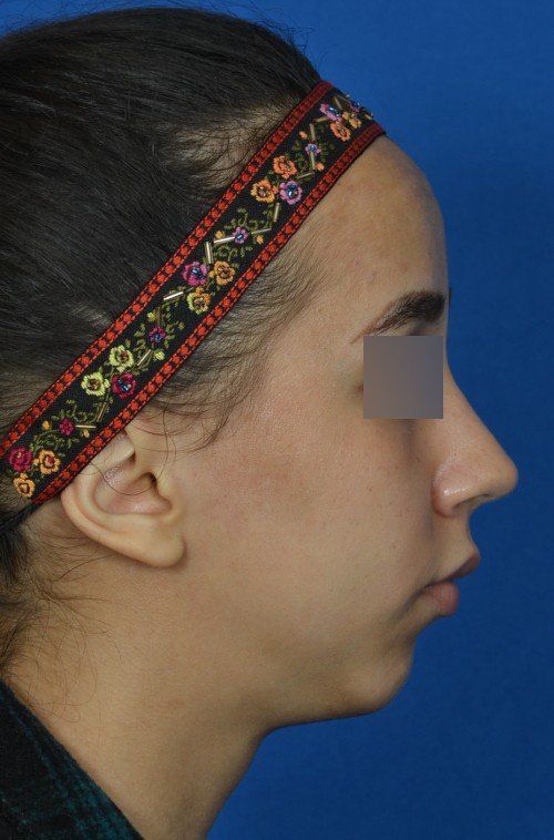girl before chin implant