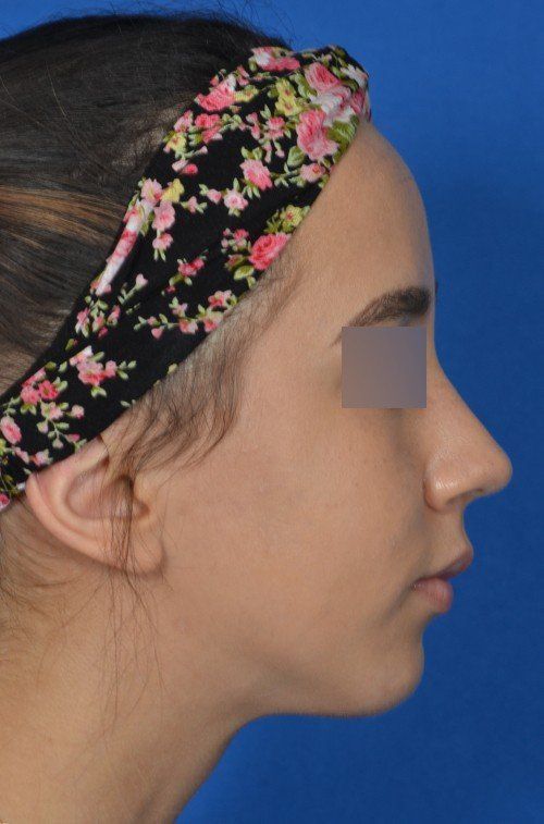 after chin implant