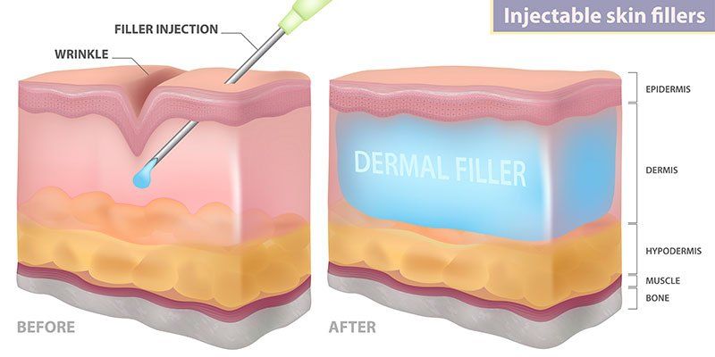 restylane filler graphic