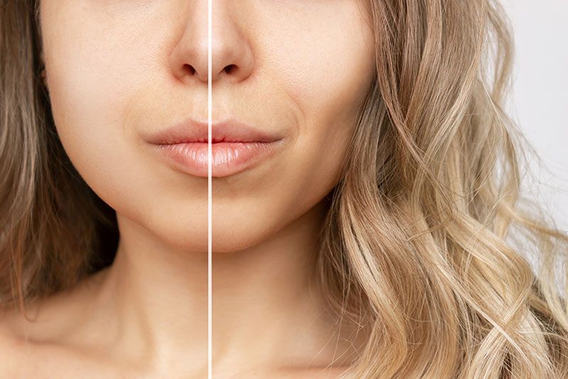 female before and after buccal fat removal