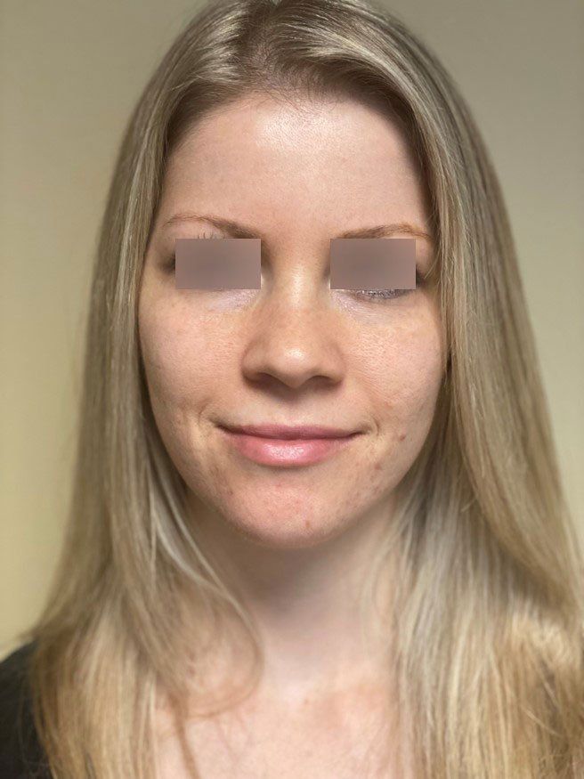 after stimulator peel