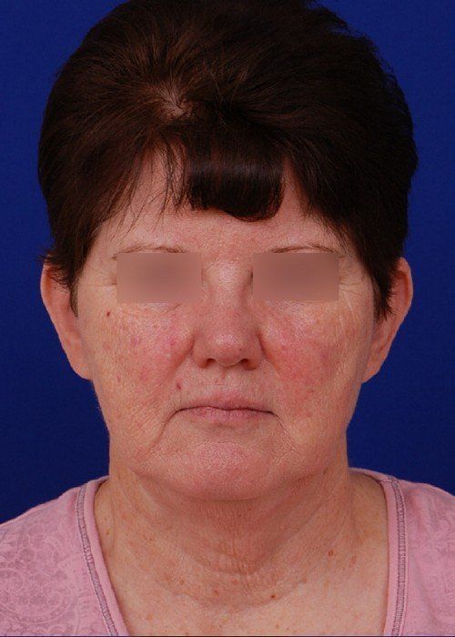 woman before facelift