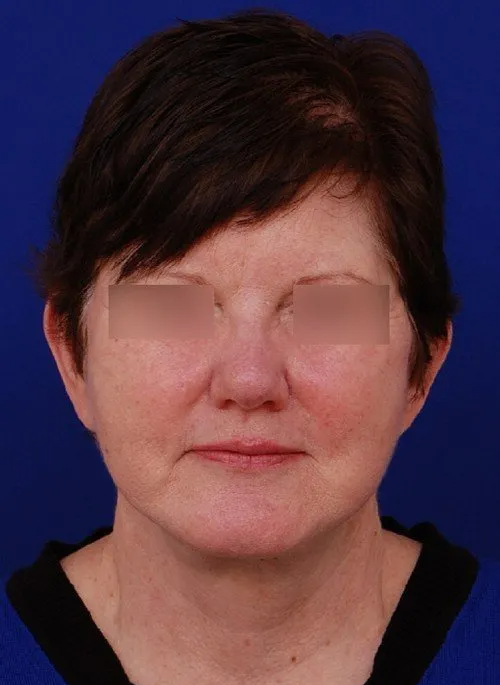 female facelift