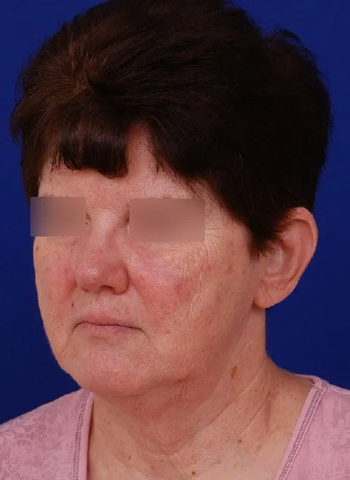 woman before facelift