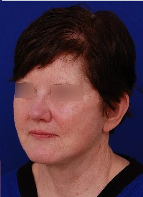 female facelift