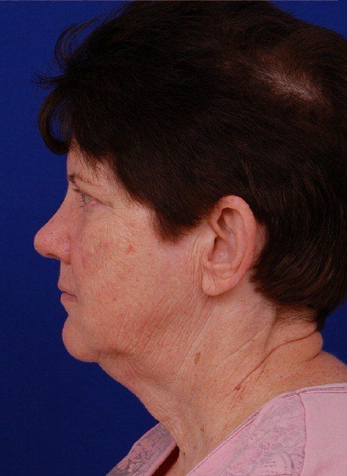 woman before facelift