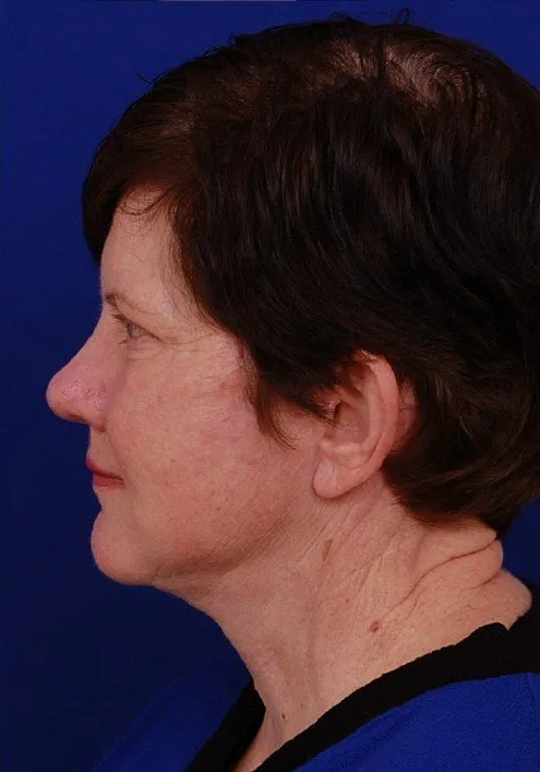 female facelift