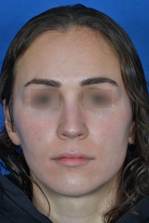 after female rhinoplasty