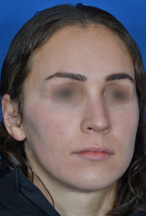 female rhinoplasty