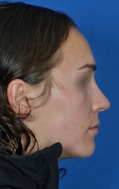 female rhinoplasty