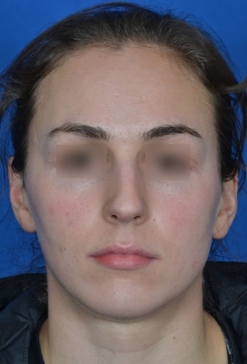 before female rhinoplasty