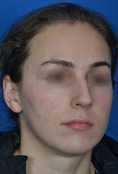 before rhinoplasty