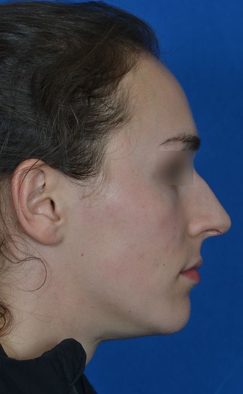before rhinoplasty