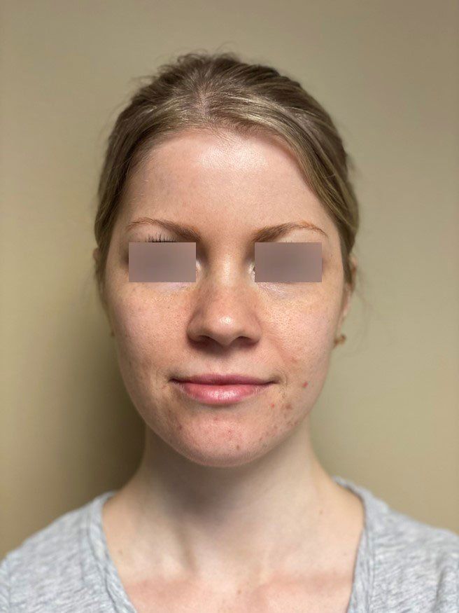 before stimulator peel