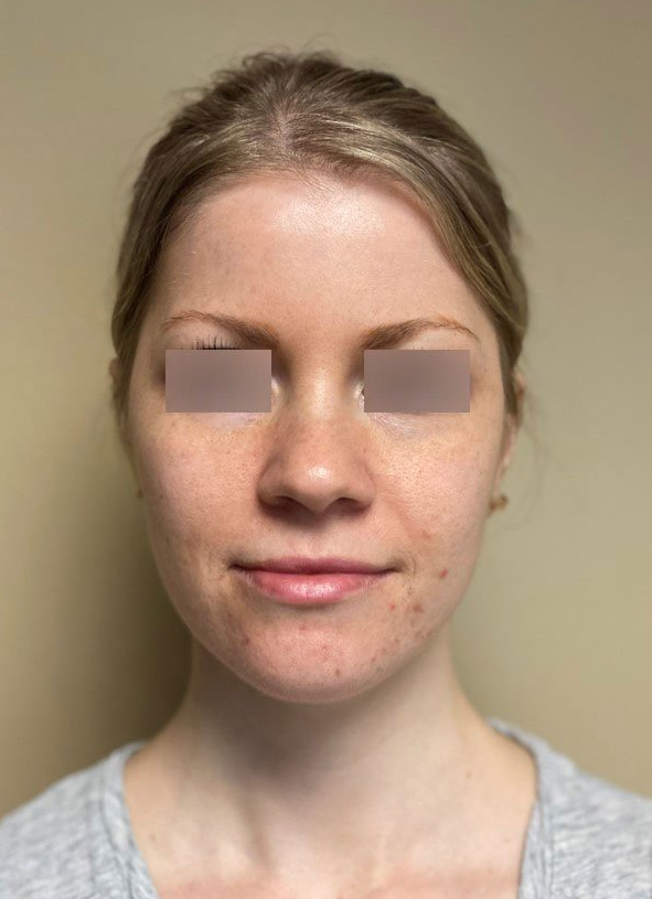 before zo stimulator peel