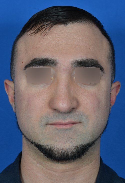 after male rhinoplasty