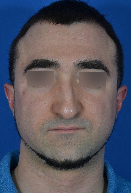 before male rhinoplasty