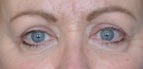 upper eyelids of woman