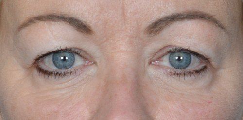 upper eyelids of woman