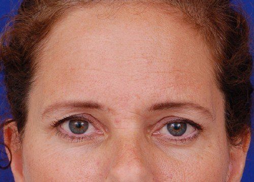brow lift before and after