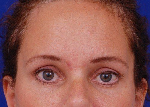 brow lift before and after