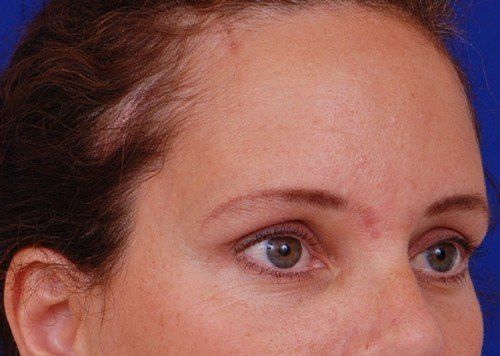 brow lift before and after