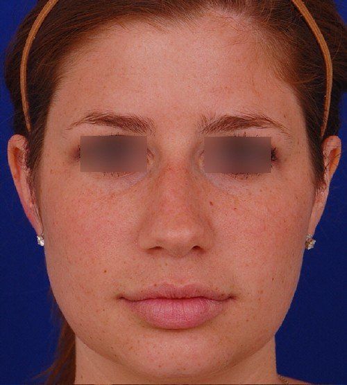 rhinoplasty