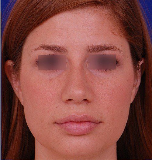 rhinoplasty
