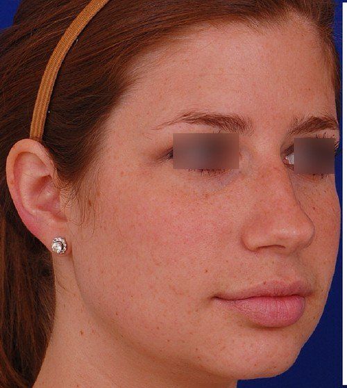 rhinoplasty