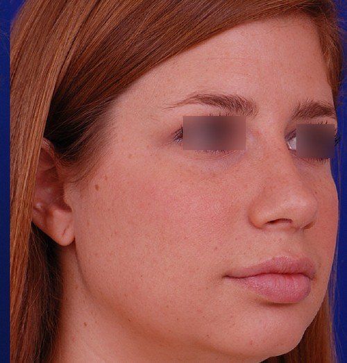 rhinoplasty