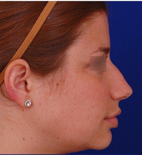 rhinoplasty