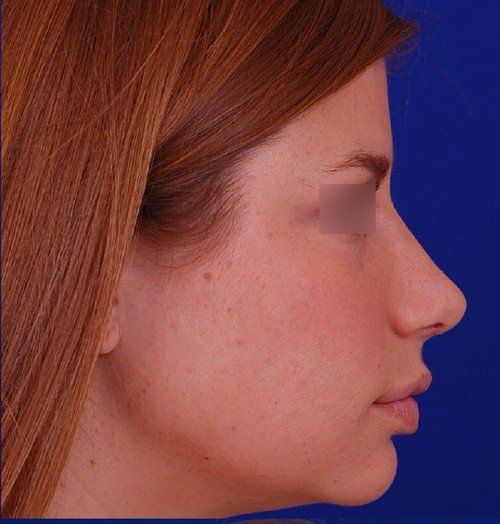 rhinoplasty