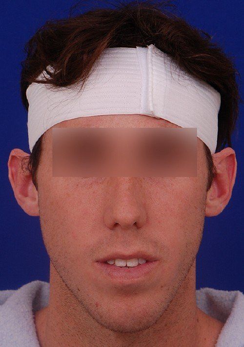 before otoplasty