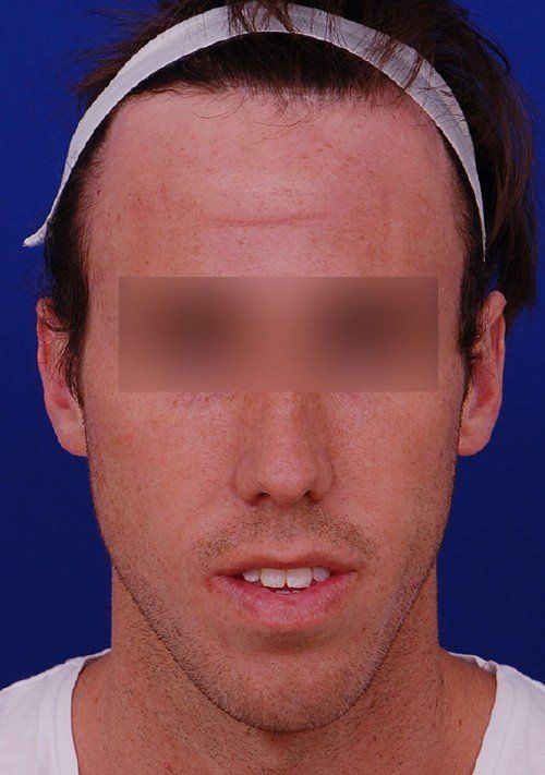 after otoplasty 