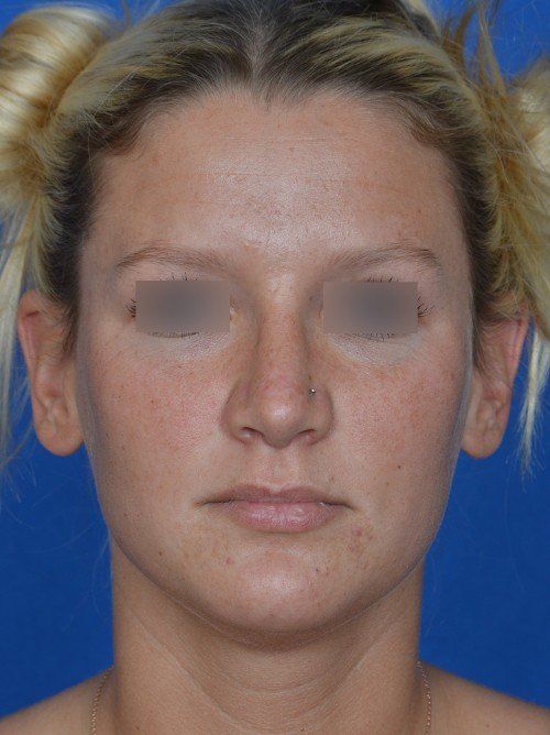rhinoplasty
