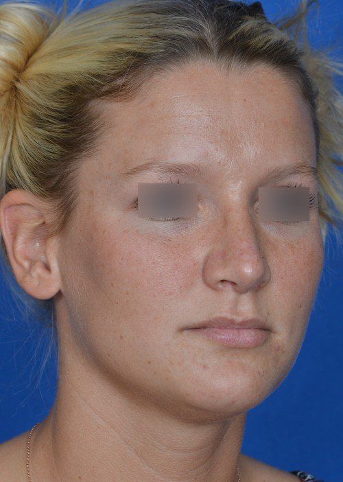 rhinoplasty