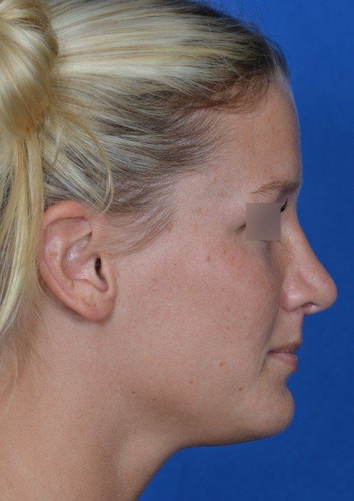 rhinoplasty