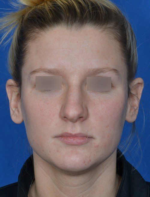 rhinoplasty
