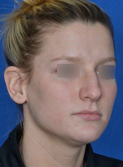 rhinoplasty