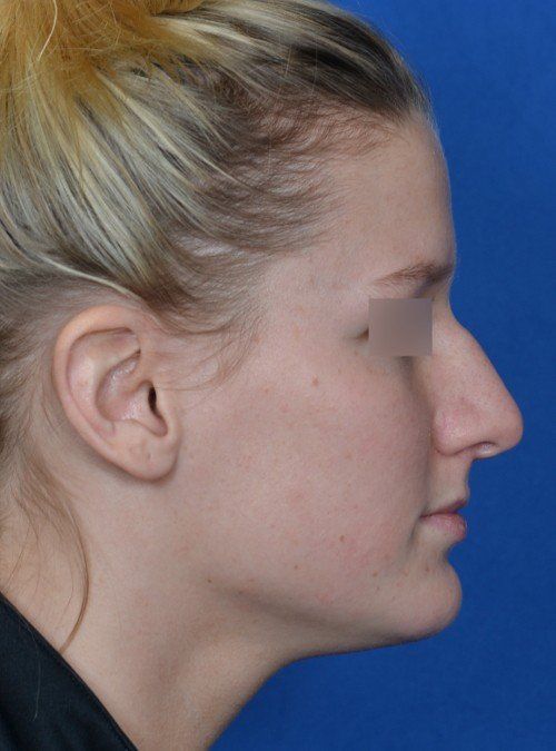 rhinoplasty