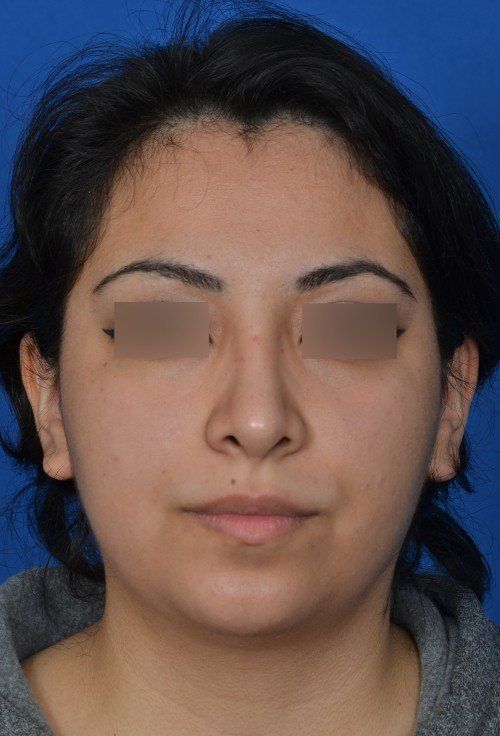 rhinoplasty