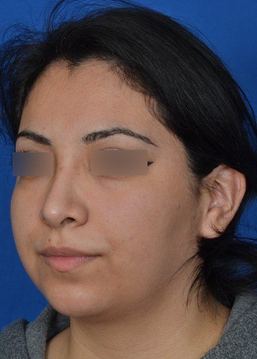 rhinoplasty