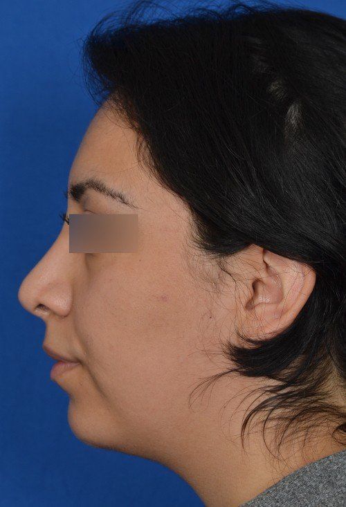rhinoplasty