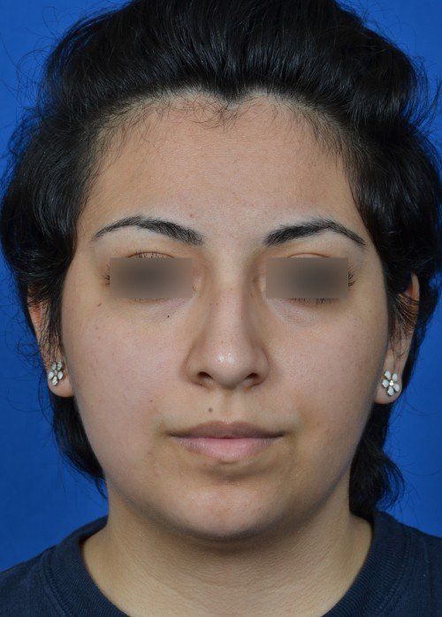 rhinoplasty
