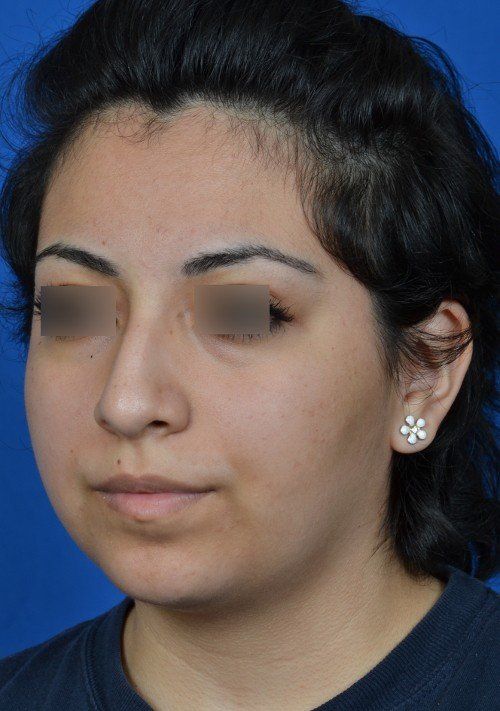 rhinoplasty
