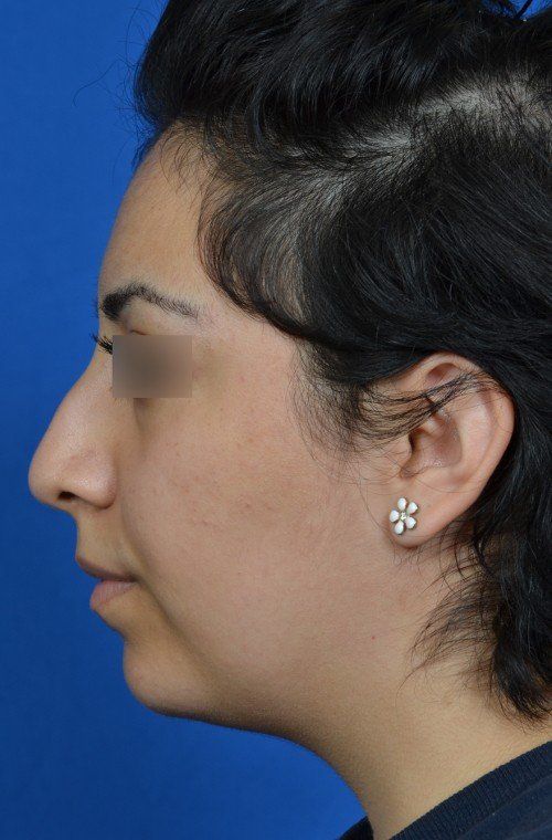 rhinoplasty