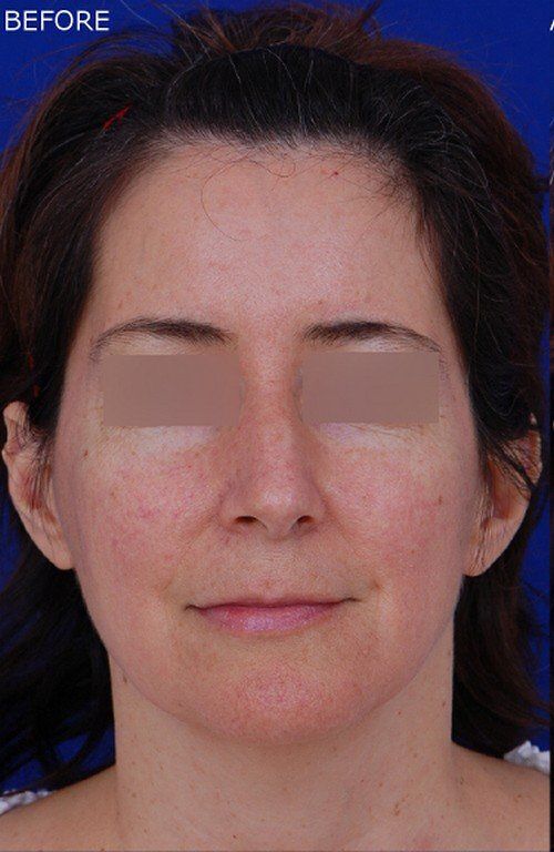 rhinoplasty
